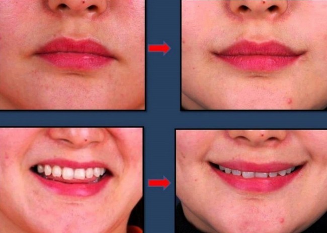 Qiziqarli ma'lumotlar: Go'zallik qurbonlik talab qiladi (+foto)