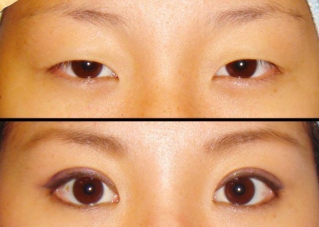 Qiziqarli ma'lumotlar: Go'zallik qurbonlik talab qiladi (+foto)