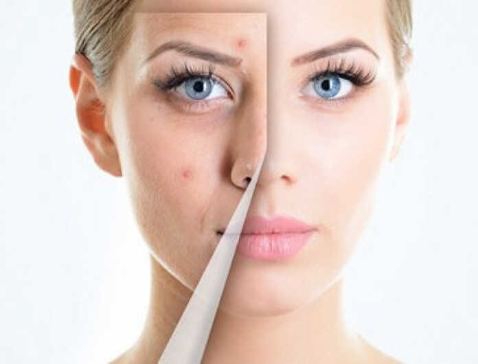 Muammo yechimini ichkaridan izlaymiz: akne paydo bo'lishiga olib keluvchi 4 mahsulot