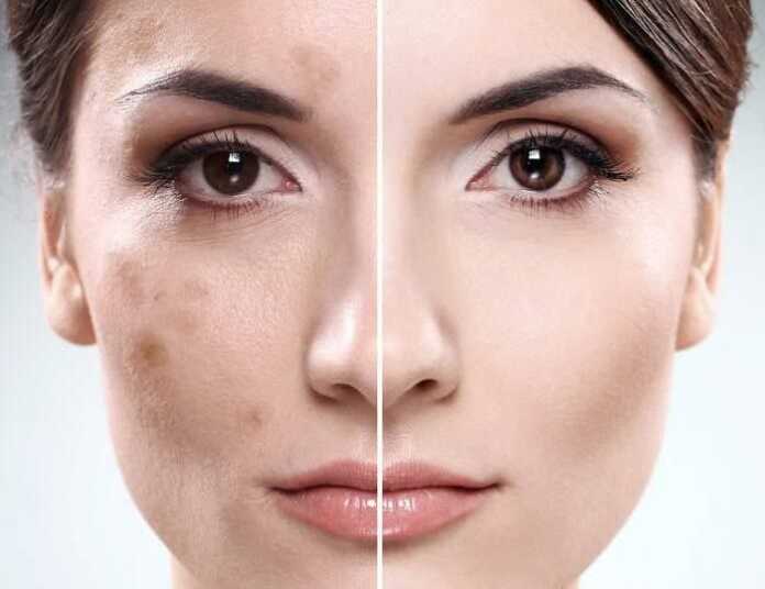 Yuzingizda qora dog'lar bormi?..