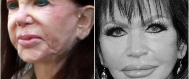 Supermodel va aktrisalar: omadsiz plastik jarrohlik qurbonlari6