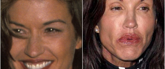 Supermodel va aktrisalar: omadsiz plastik jarrohlik qurbonlari1