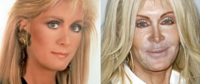 Supermodel va aktrisalar: omadsiz plastik jarrohlik qurbonlari5