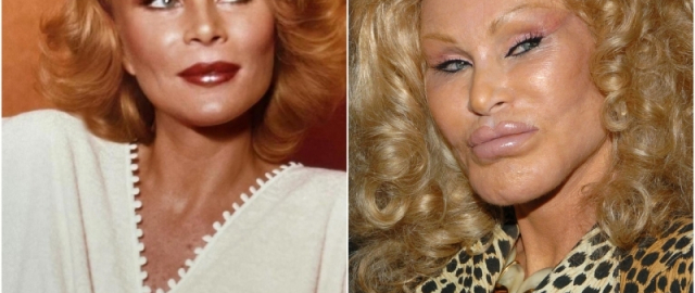 Supermodel va aktrisalar: omadsiz plastik jarrohlik qurbonlari3