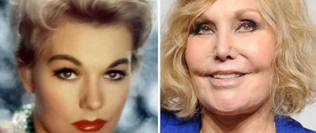 Supermodel va aktrisalar: omadsiz plastik jarrohlik qurbonlari4